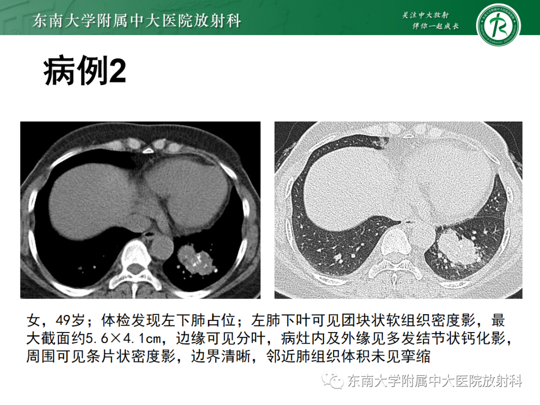 影像PPT - 【PPT】肺硬化性肺细胞瘤-15