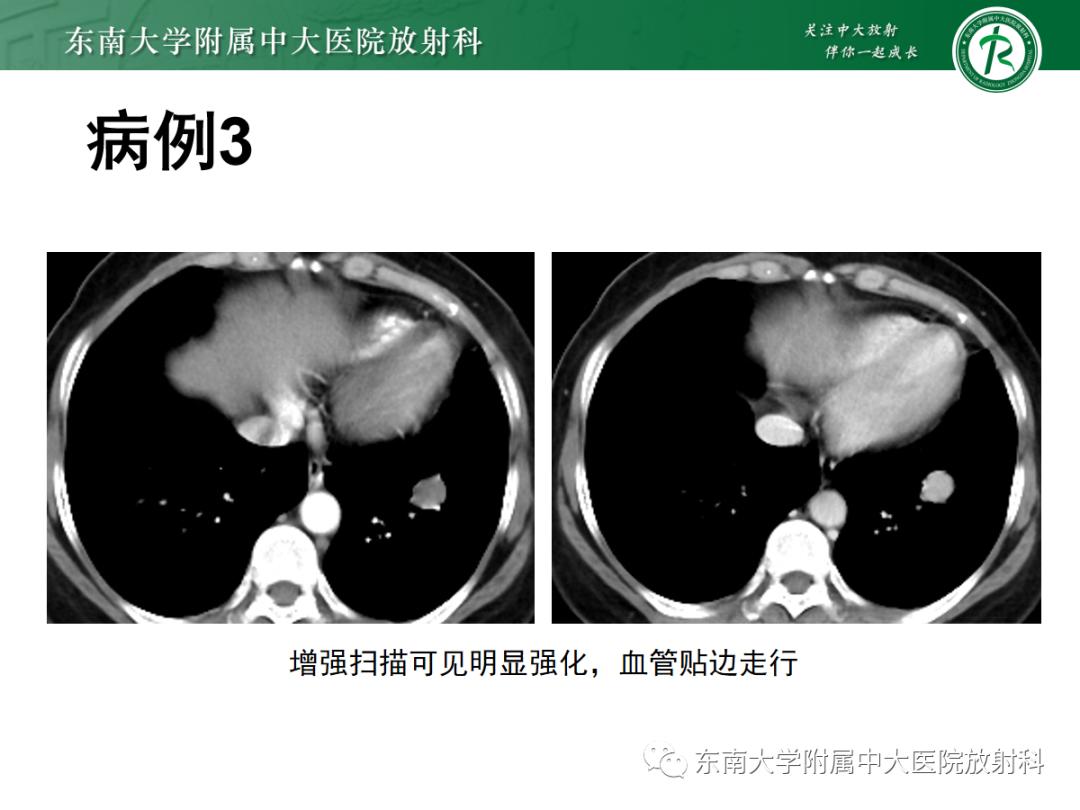 影像PPT - 【PPT】肺硬化性肺细胞瘤-19