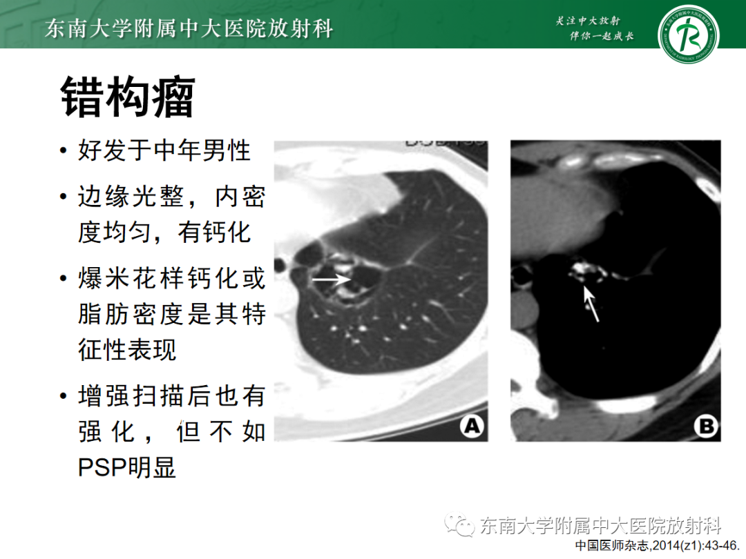 影像PPT - 【PPT】肺硬化性肺细胞瘤-23