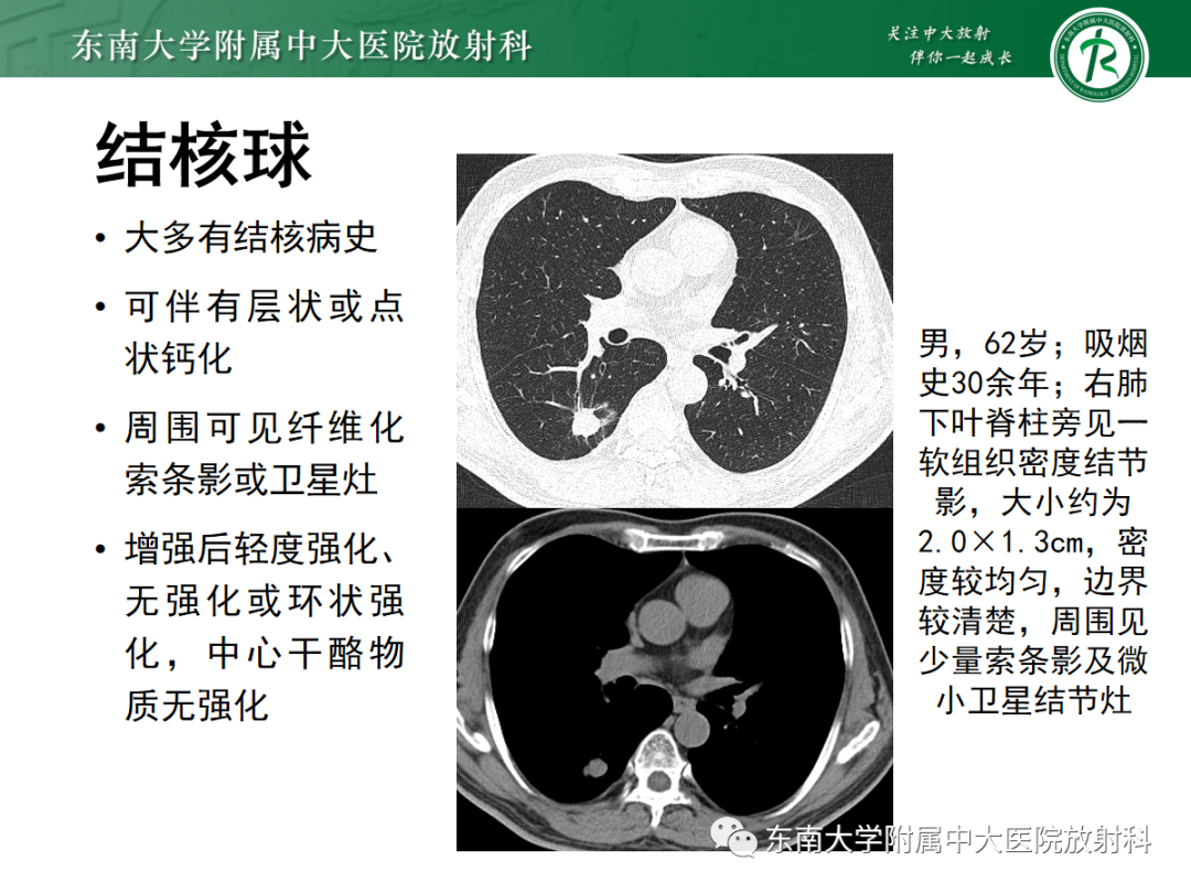 影像PPT - 【PPT】肺硬化性肺细胞瘤-25