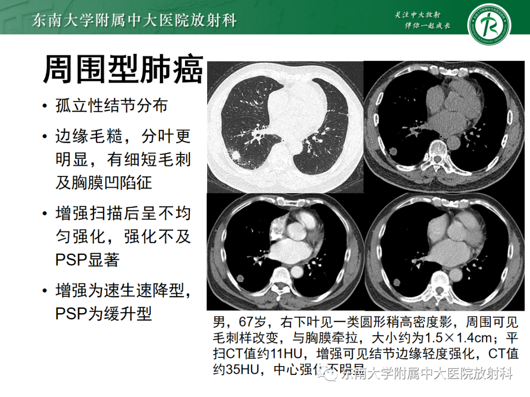影像PPT - 【PPT】肺硬化性肺细胞瘤-24
