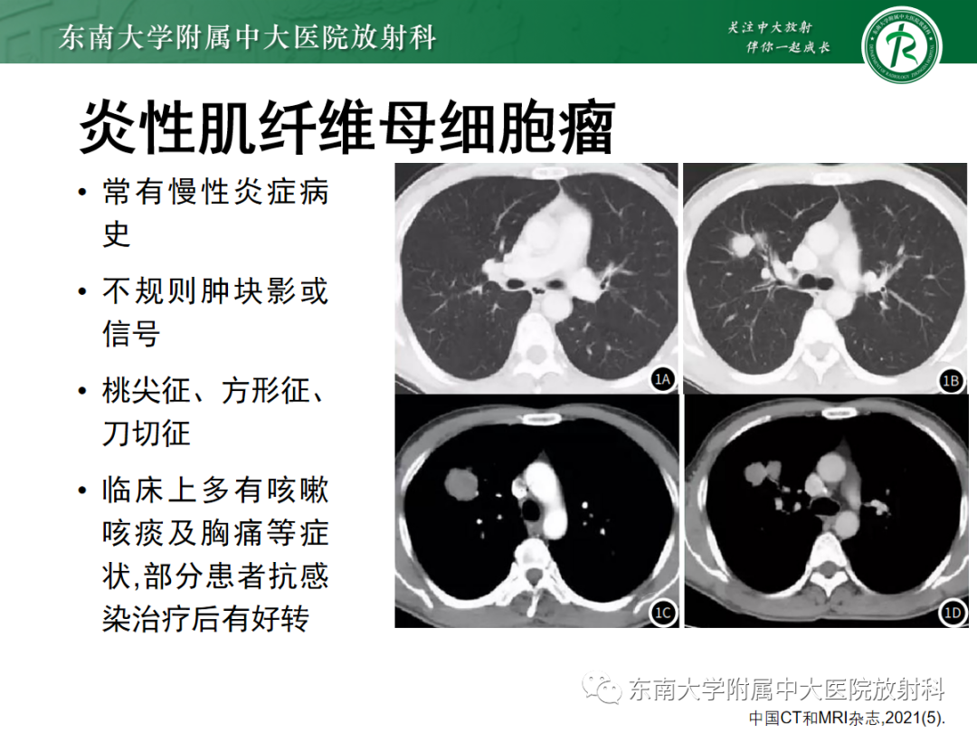 影像PPT - 【PPT】肺硬化性肺细胞瘤-22