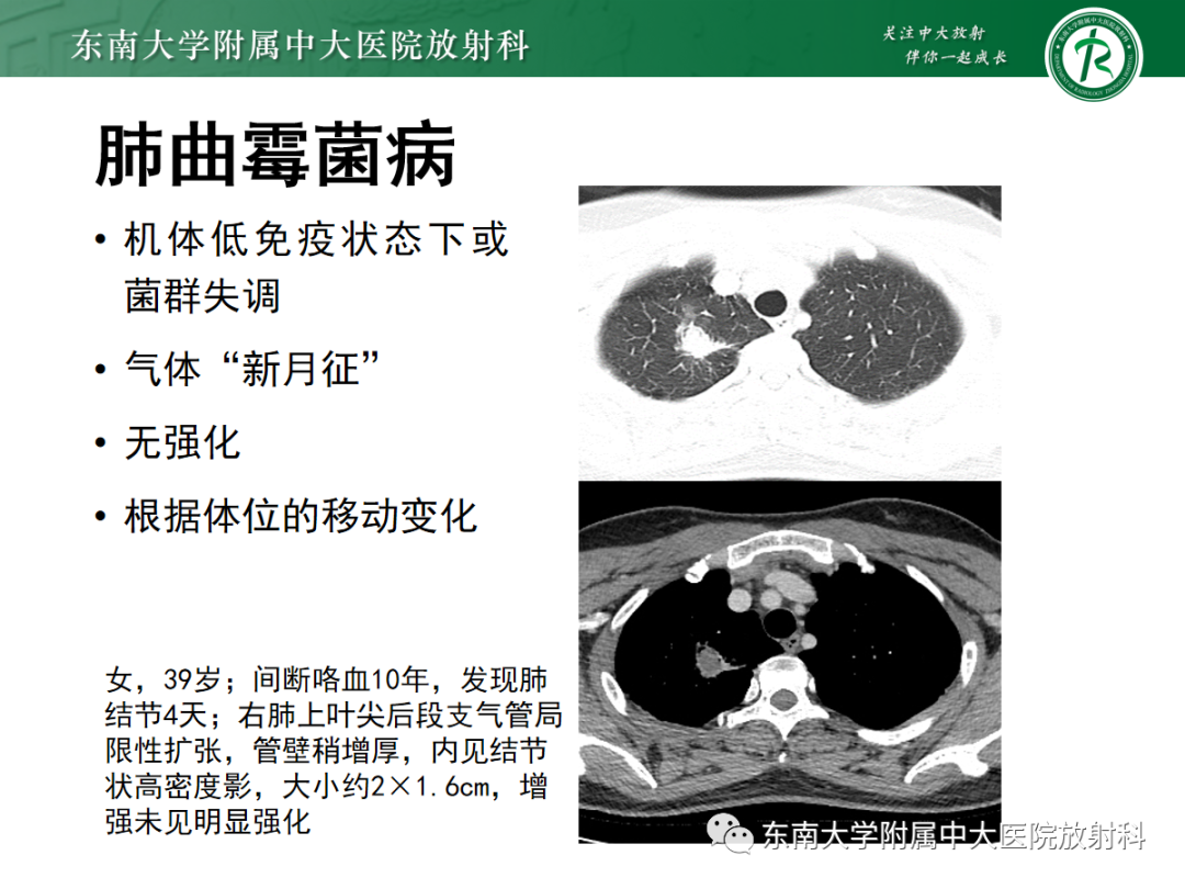 影像PPT - 【PPT】肺硬化性肺细胞瘤-26