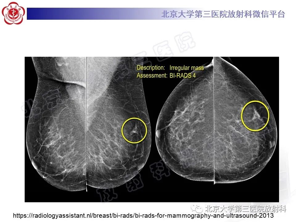 影像PPT - 【PPT】第五版BI-RADS分类解读（乳腺X线摄影）-16