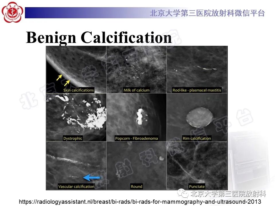 影像PPT - 【PPT】第五版BI-RADS分类解读（乳腺X线摄影）-19