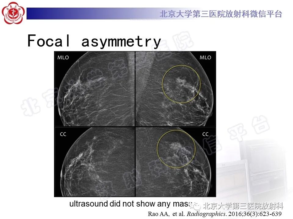 影像PPT - 【PPT】第五版BI-RADS分类解读（乳腺X线摄影）-24