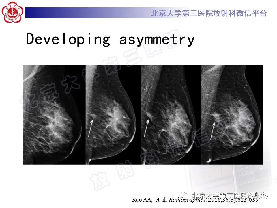 影像PPT - 【PPT】第五版BI-RADS分类解读（乳腺X线摄影）-25