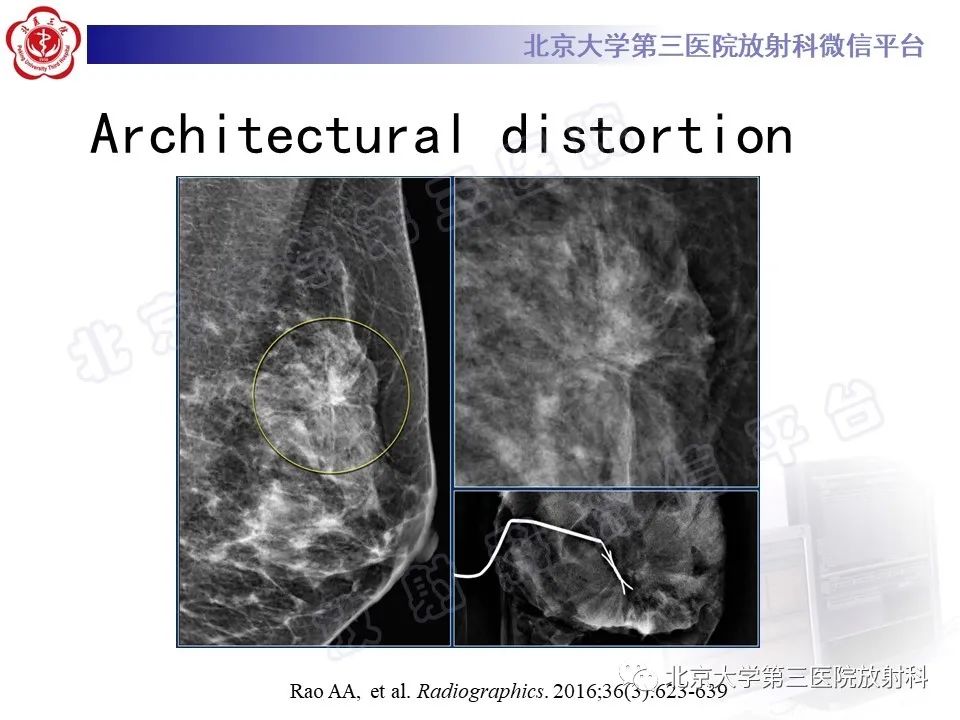影像PPT - 【PPT】第五版BI-RADS分类解读（乳腺X线摄影）-26