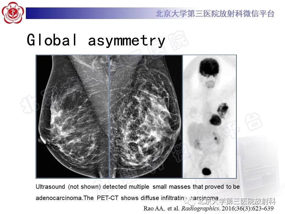 影像PPT - 【PPT】第五版BI-RADS分类解读（乳腺X线摄影）-27