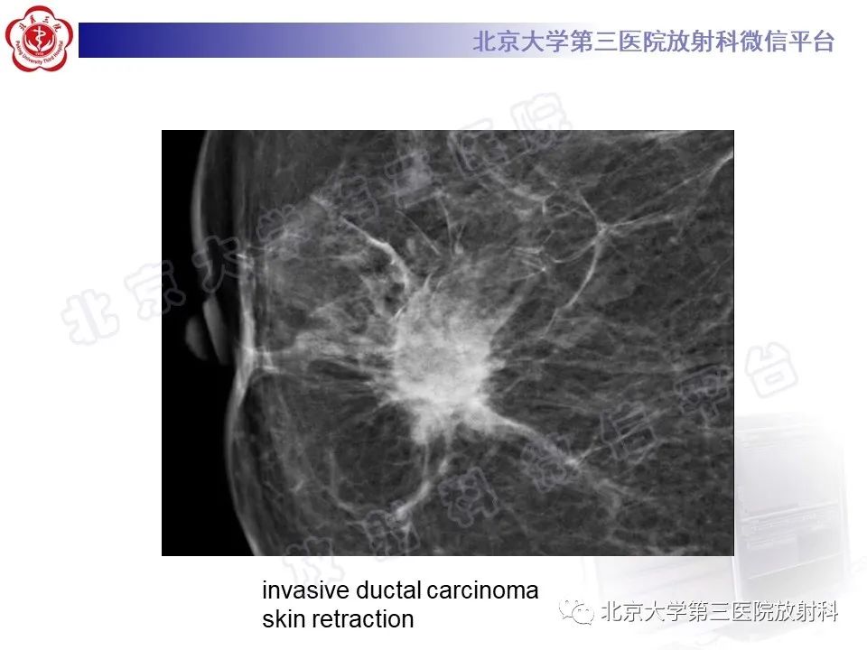 影像PPT - 【PPT】第五版BI-RADS分类解读（乳腺X线摄影）-28