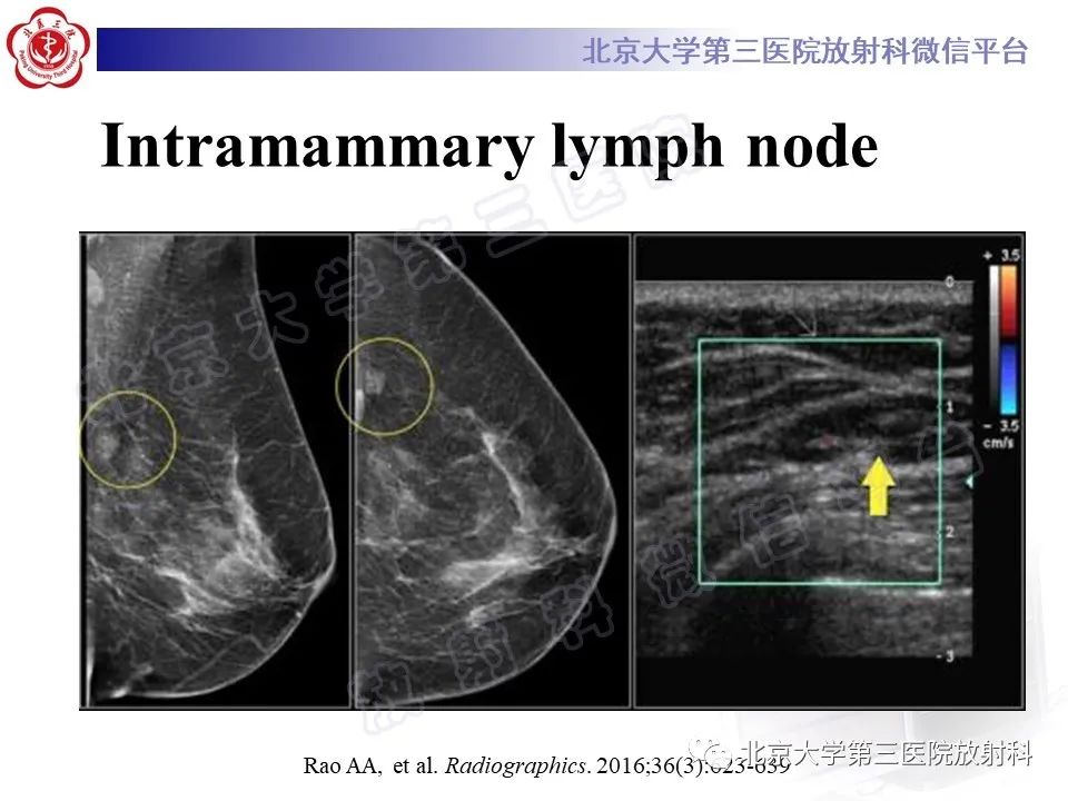 影像PPT - 【PPT】第五版BI-RADS分类解读（乳腺X线摄影）-29