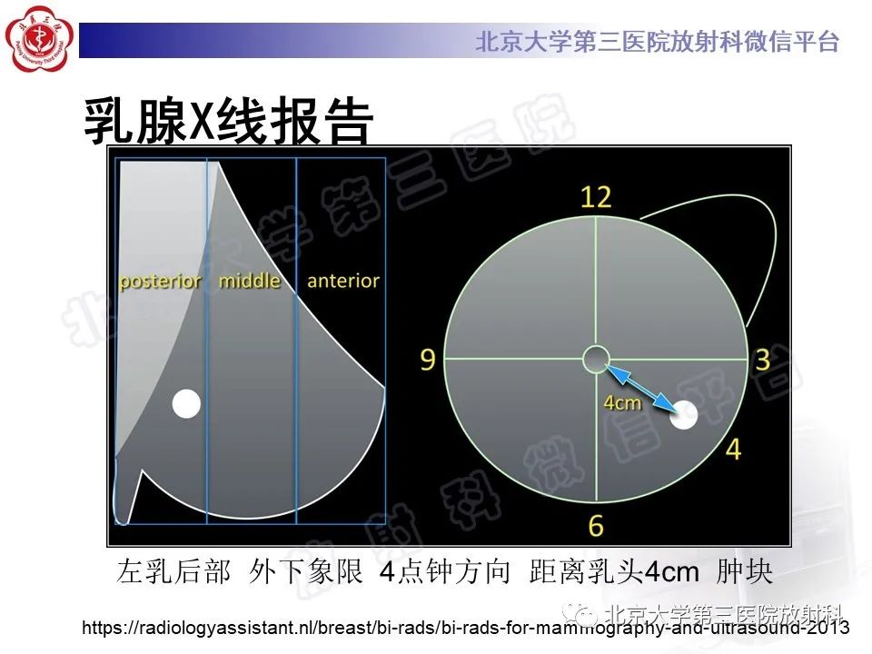 影像PPT - 【PPT】第五版BI-RADS分类解读（乳腺X线摄影）-34