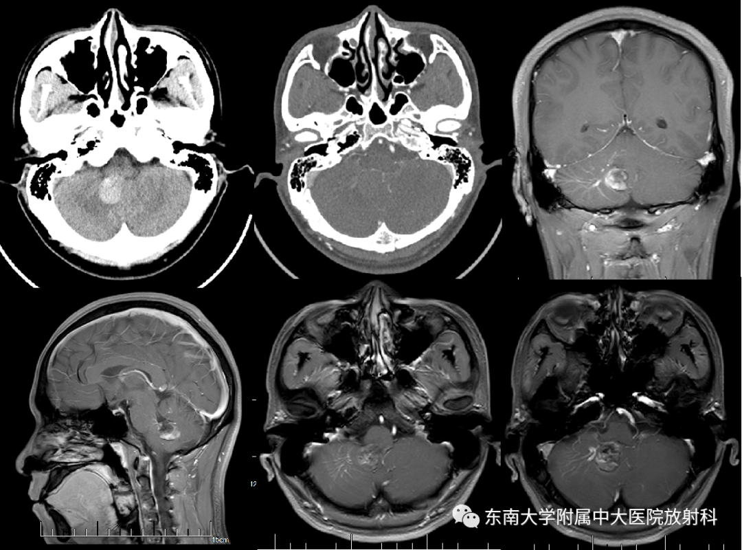 影像PPT - 【PPT】颅内海绵状血管畸形-1