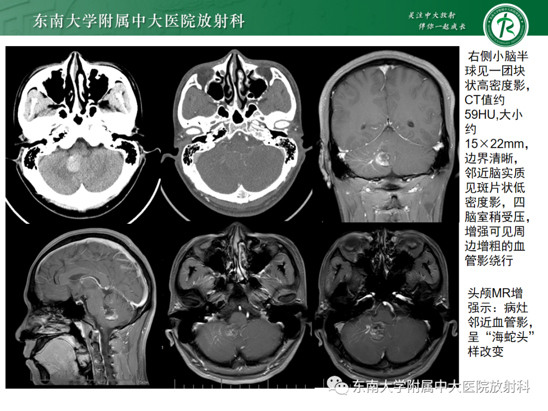 影像PPT - 【PPT】颅内海绵状血管畸形-2