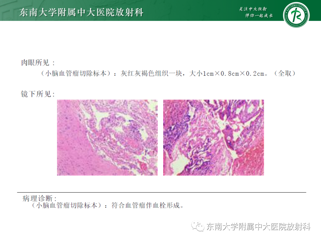 影像PPT - 【PPT】颅内海绵状血管畸形-3