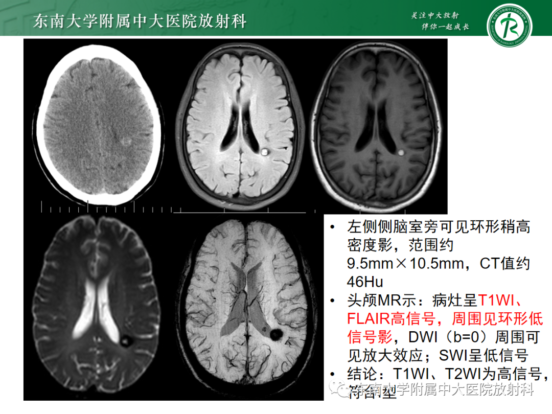 影像PPT - 【PPT】颅内海绵状血管畸形-14