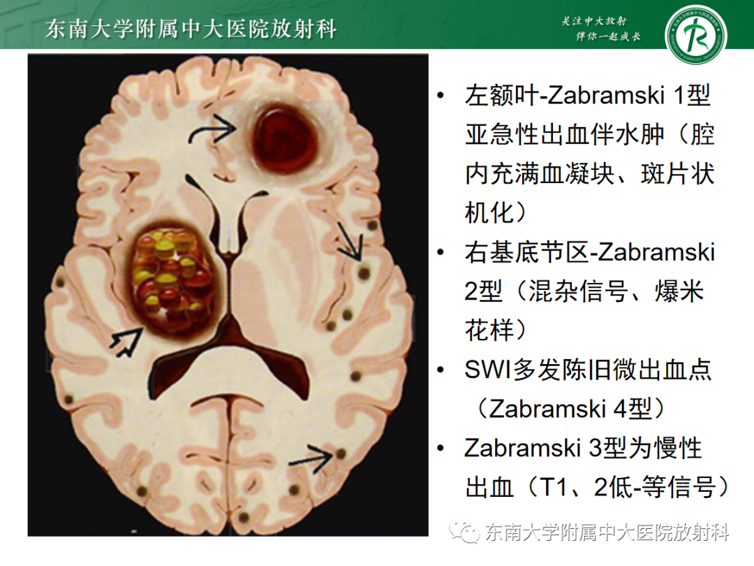 影像PPT - 【PPT】颅内海绵状血管畸形-13
