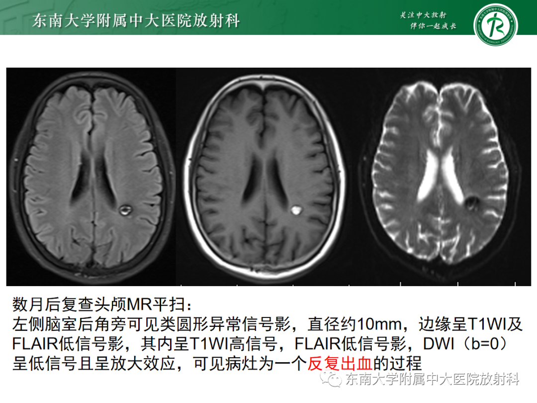 影像PPT - 【PPT】颅内海绵状血管畸形-15
