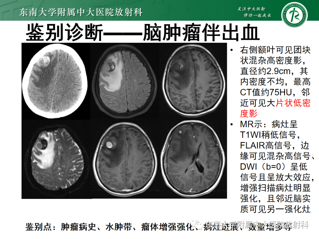 影像PPT - 【PPT】颅内海绵状血管畸形-17