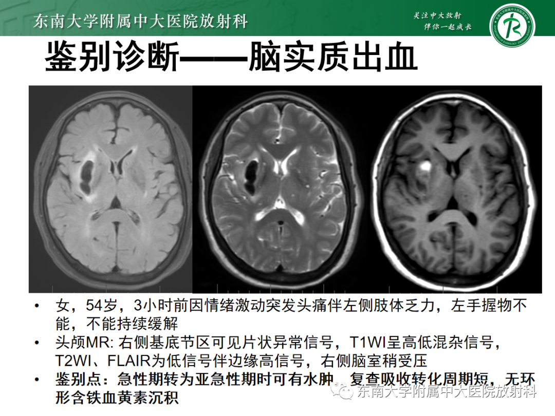 影像PPT - 【PPT】颅内海绵状血管畸形-16