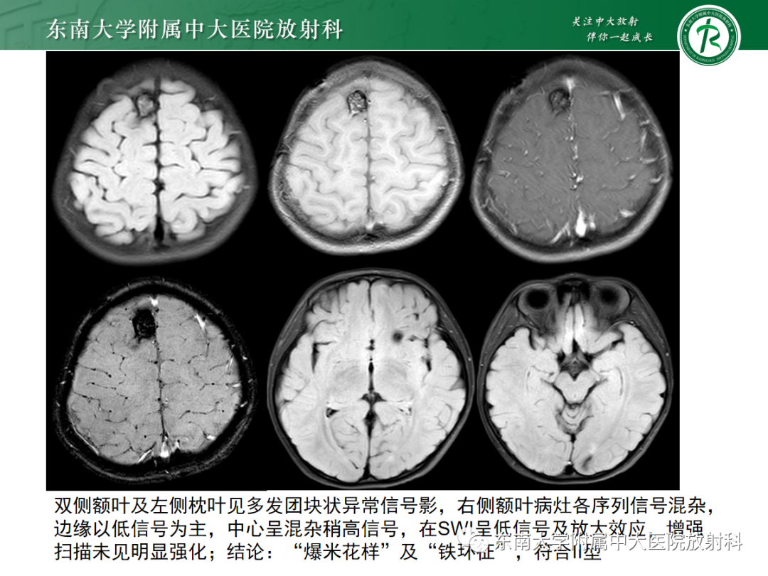 影像PPT - 【PPT】颅内海绵状血管畸形-19
