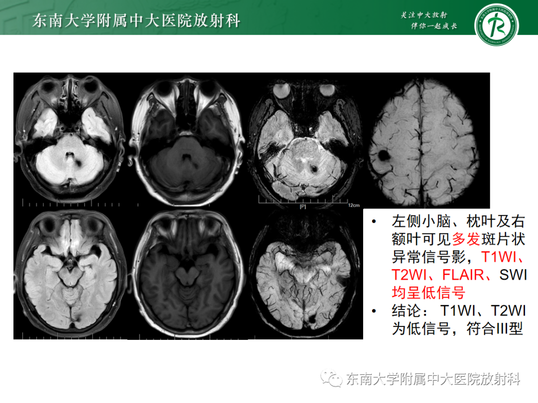 影像PPT - 【PPT】颅内海绵状血管畸形-21