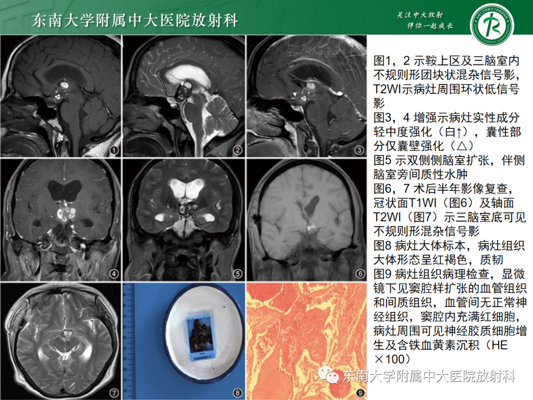 影像PPT - 【PPT】颅内海绵状血管畸形-24