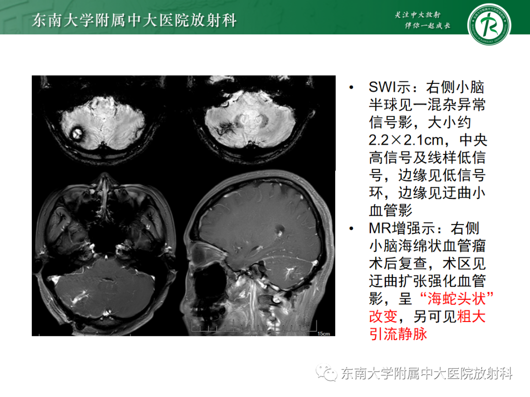 影像PPT - 【PPT】颅内海绵状血管畸形-28