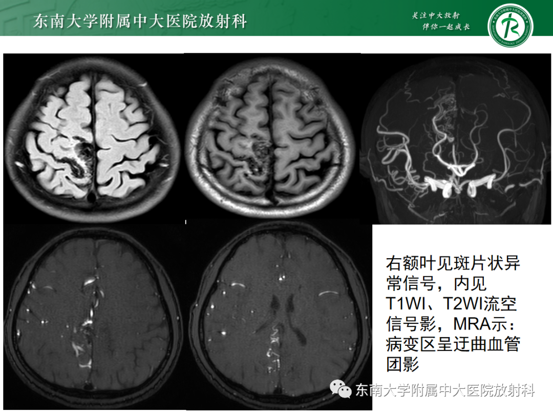 影像PPT - 【PPT】颅内海绵状血管畸形-31