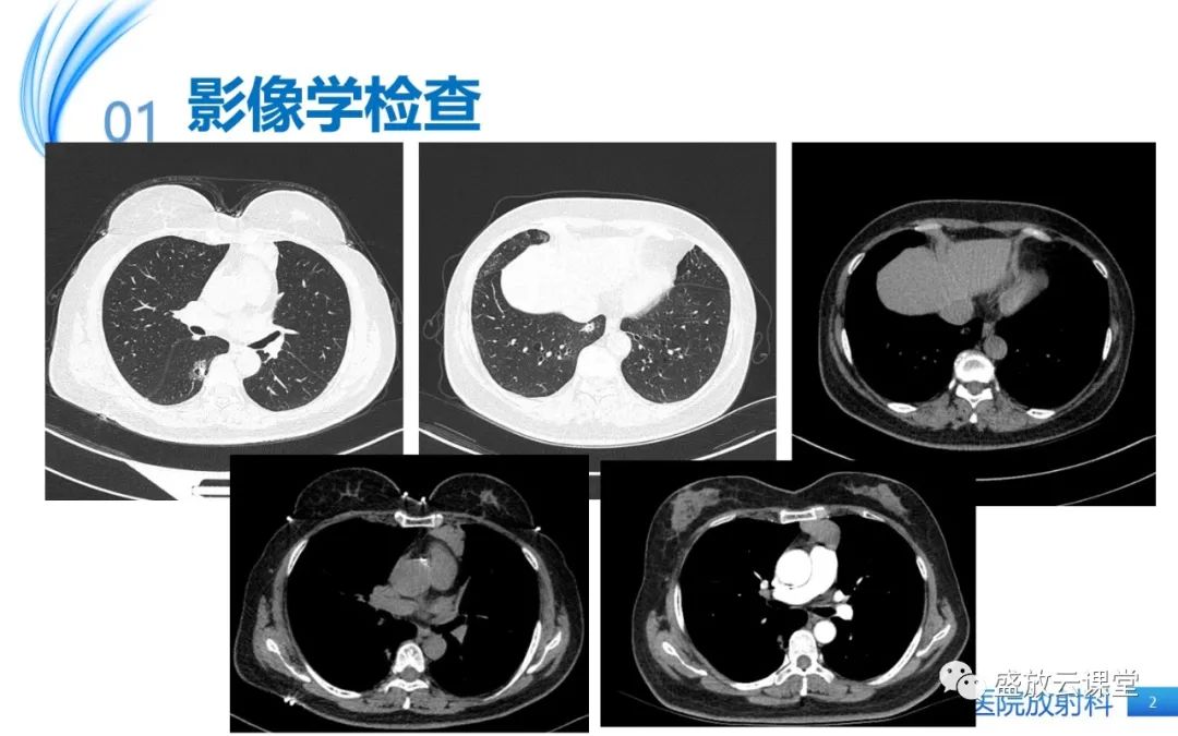 影像PPT - 【病例】肺淋巴瘤1例CT影像-2