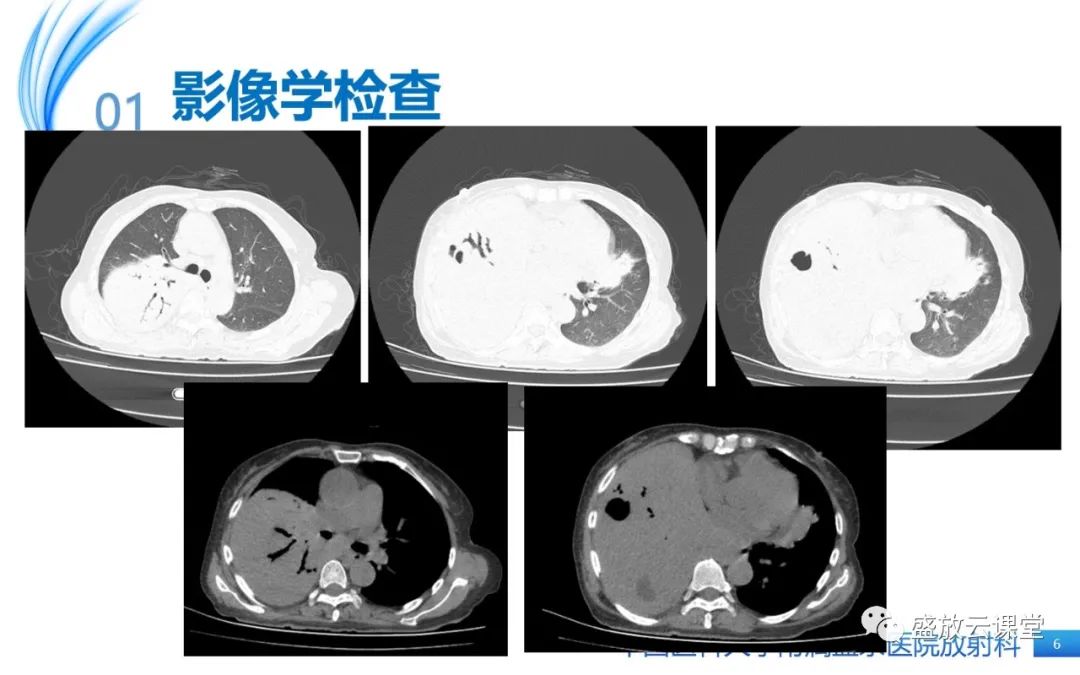 影像PPT - 【病例】肺淋巴瘤1例CT影像-6