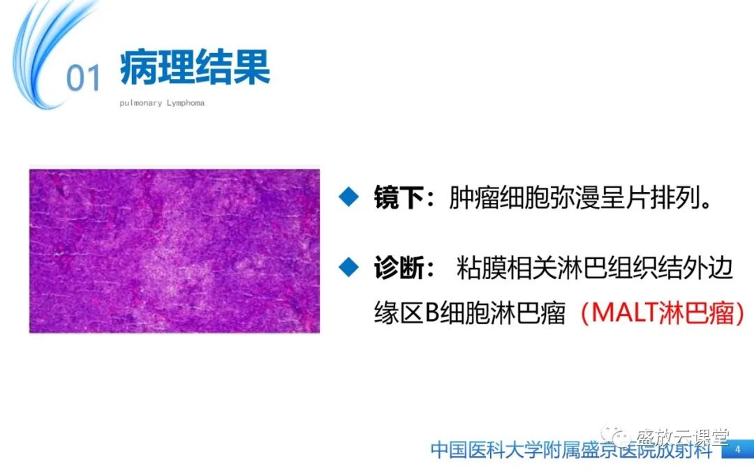 影像PPT - 【病例】肺淋巴瘤1例CT影像-4