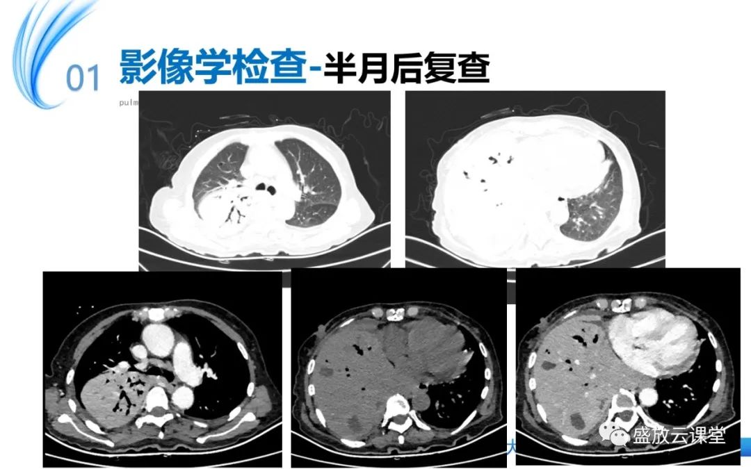 影像PPT - 【病例】肺淋巴瘤1例CT影像-7