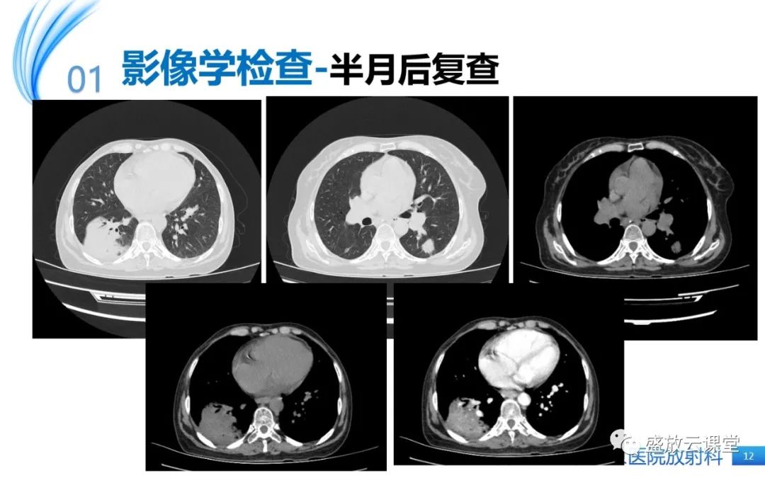 影像PPT - 【病例】肺淋巴瘤1例CT影像-11
