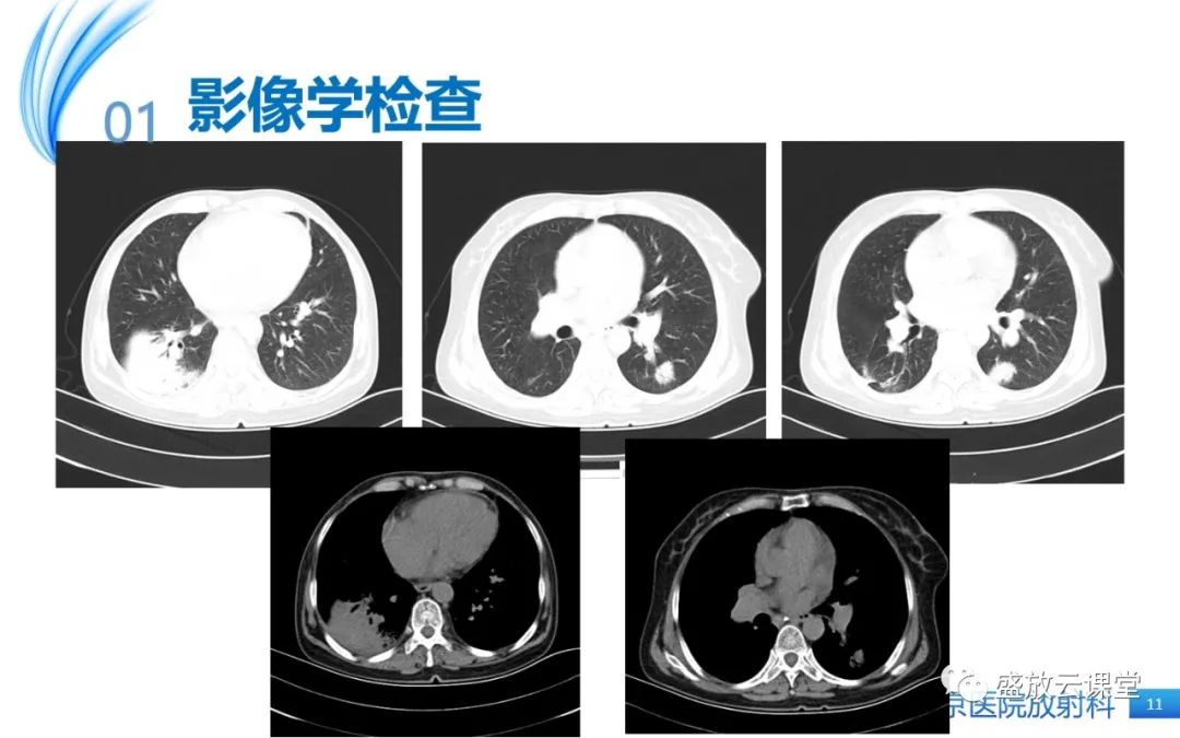 影像PPT - 【病例】肺淋巴瘤1例CT影像-10