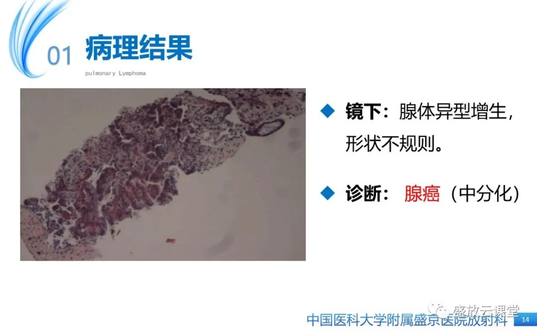影像PPT - 【病例】肺淋巴瘤1例CT影像-12