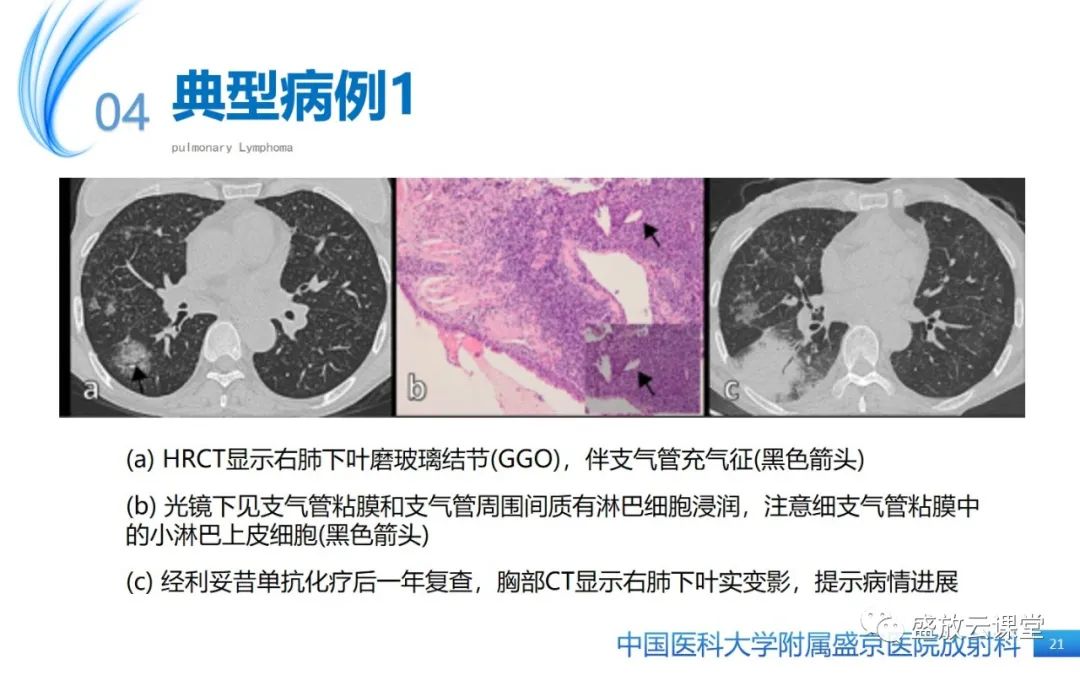 影像PPT - 【病例】肺淋巴瘤1例CT影像-19