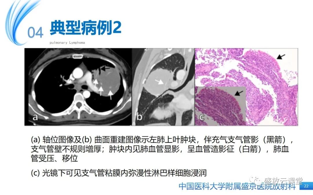 影像PPT - 【病例】肺淋巴瘤1例CT影像-20