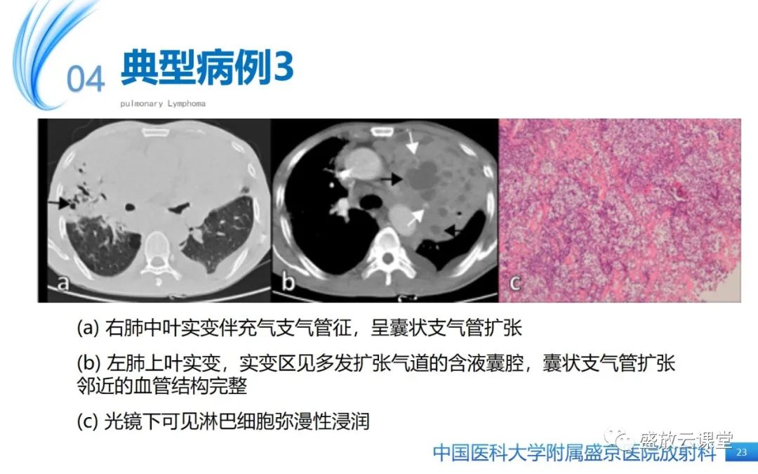 影像PPT - 【病例】肺淋巴瘤1例CT影像-21