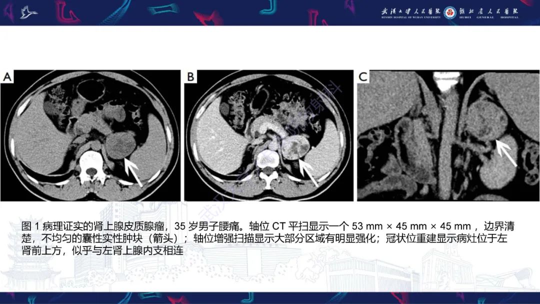 影像PPT - 【PPT】肾上腺常见病变CT及MRI诊断-8