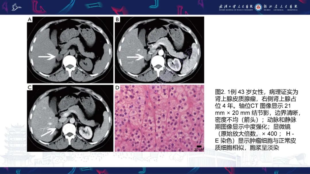 影像PPT - 【PPT】肾上腺常见病变CT及MRI诊断-9