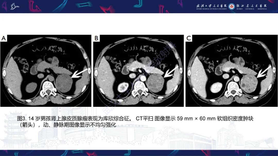 影像PPT - 【PPT】肾上腺常见病变CT及MRI诊断-10