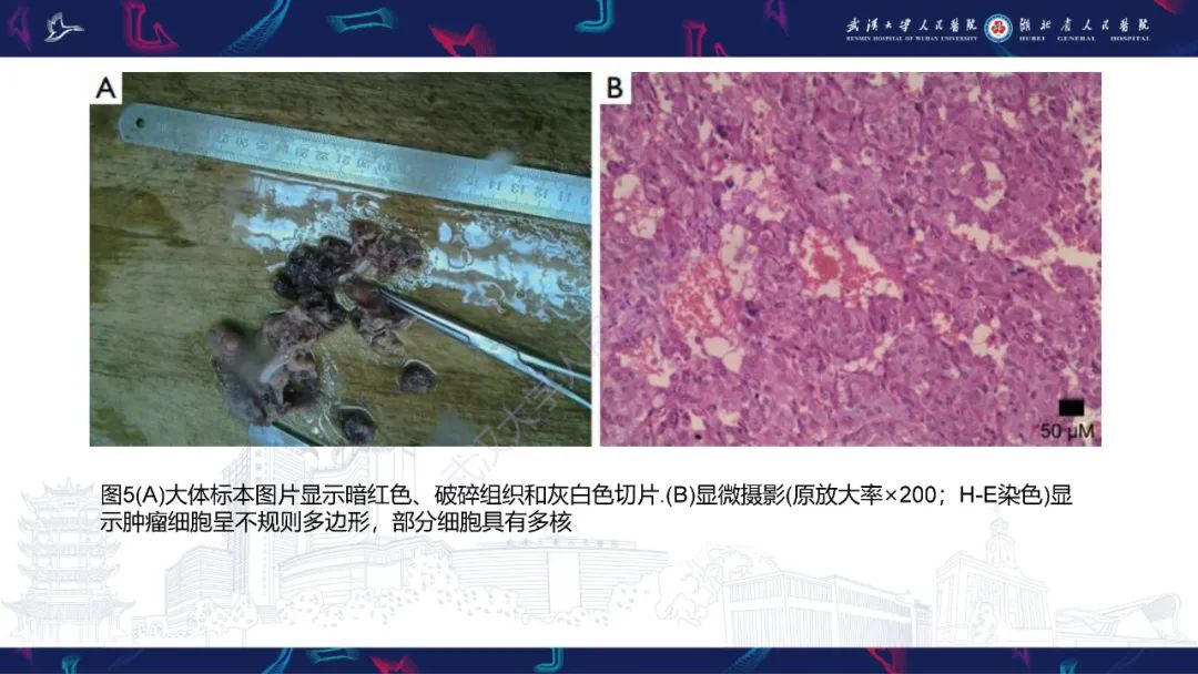 影像PPT - 【PPT】肾上腺常见病变CT及MRI诊断-14
