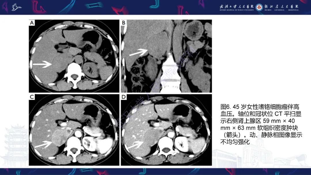 影像PPT - 【PPT】肾上腺常见病变CT及MRI诊断-15