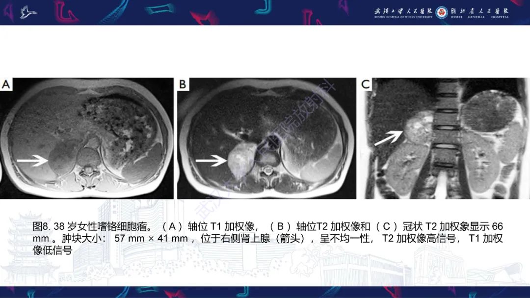 影像PPT - 【PPT】肾上腺常见病变CT及MRI诊断-17