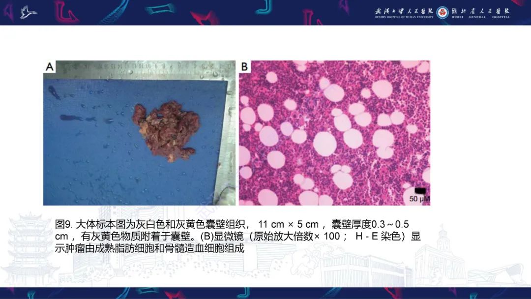 影像PPT - 【PPT】肾上腺常见病变CT及MRI诊断-19