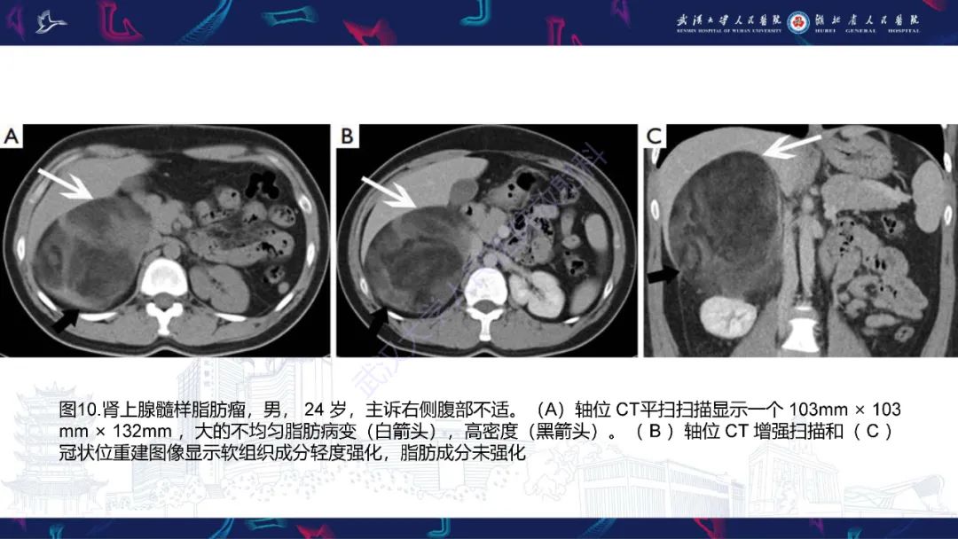 影像PPT - 【PPT】肾上腺常见病变CT及MRI诊断-20