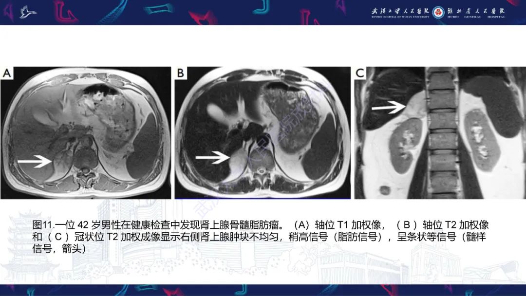 影像PPT - 【PPT】肾上腺常见病变CT及MRI诊断-21