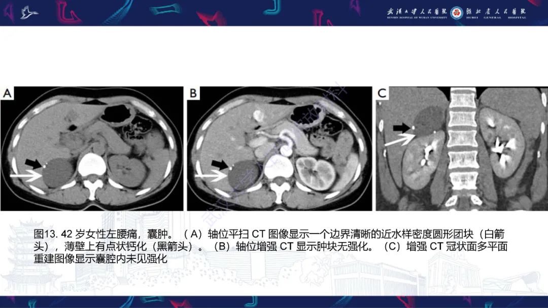 影像PPT - 【PPT】肾上腺常见病变CT及MRI诊断-24