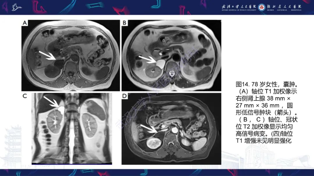 影像PPT - 【PPT】肾上腺常见病变CT及MRI诊断-25
